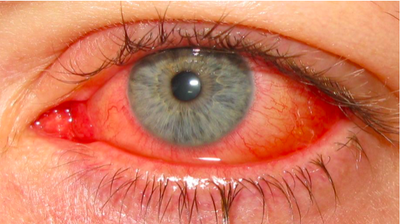 conjonctivite-eyeneed-blog