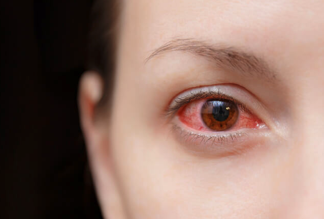 conjonctivite-eyeneed-blog